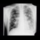 Lung metastases, cannon ball metastases: X-ray - Plain radiograph